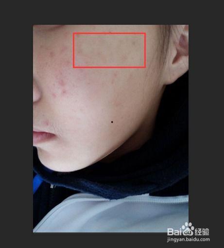 视频怎么p痘痘,轻松掌握P掉痘痘的神奇技巧